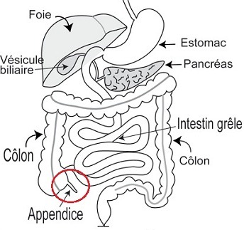 kindle-operation-appendicite